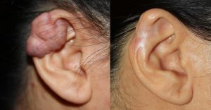 Recurrent earlobe keloid despite 2 surgeries and radiation therapy.