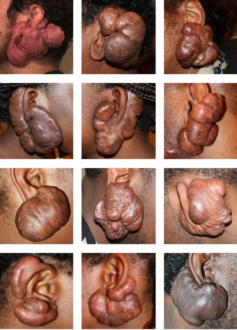 Massive Ear Keloid