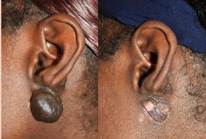 Earlobe Keloid - Interim Treatment Results with Cryotherapy