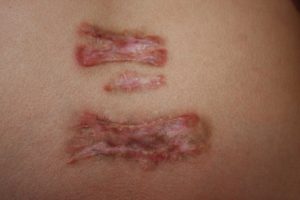 Hyperinflammatory Chest Keloid - Treated