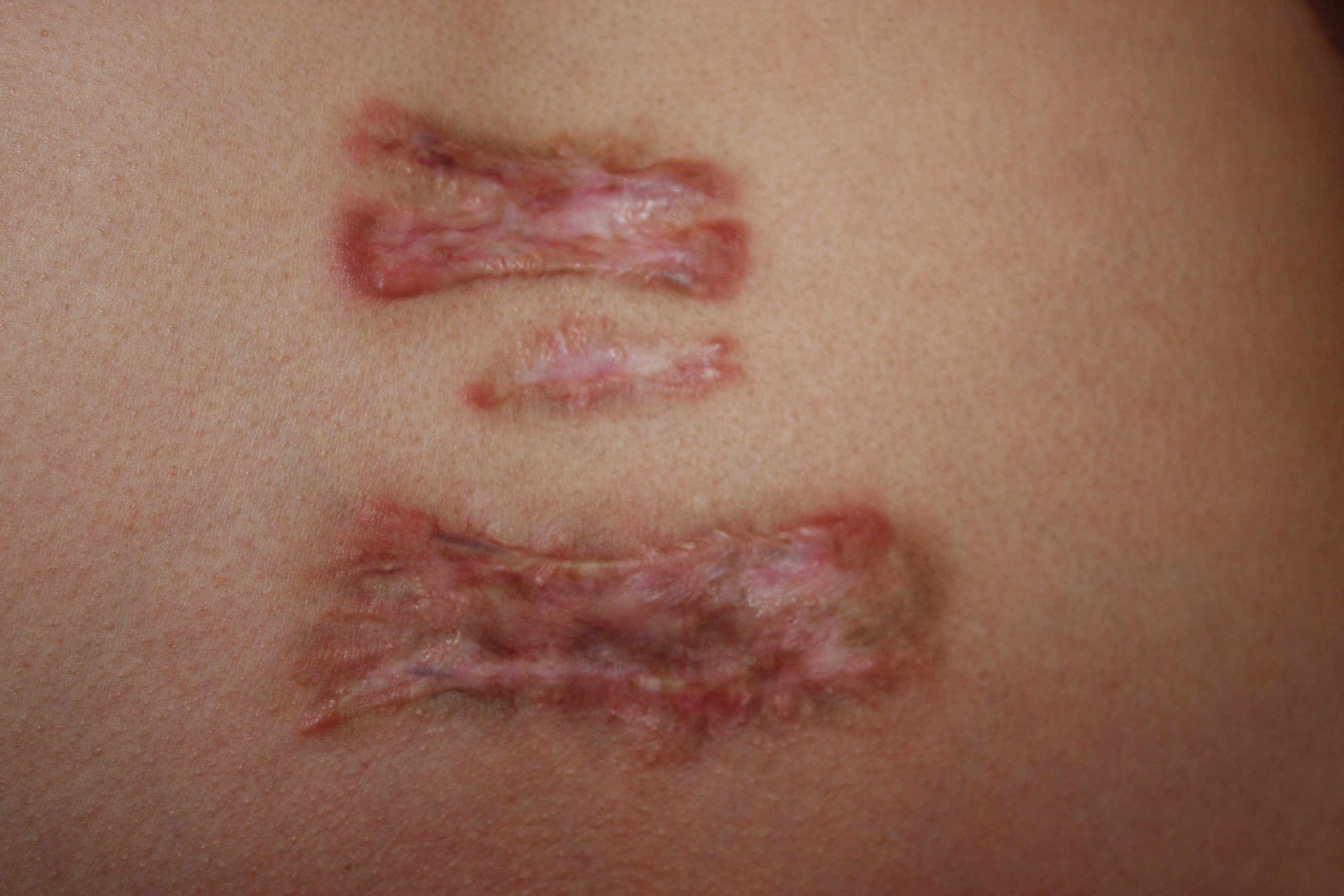 Hyper-inflammatory chest keloids - Treated with chemotherapy