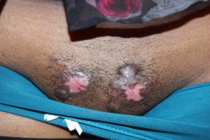 Pubic Keloids - Treatment with Cryotherapy