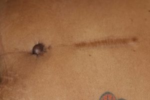 Umbilical Keloid - Recurrence affter Treatment