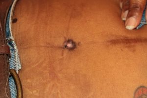 Umbilical Keloid - Treatment Results