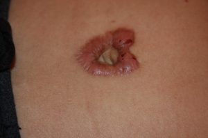 Circular Umbilical Keloid