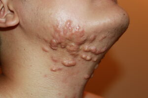 Difuse Neck and Face Keloids