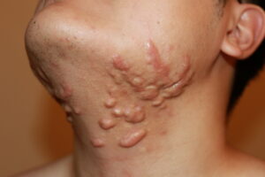 Difuse Neck and Face Keloids