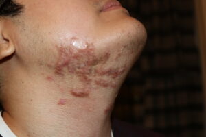 Difuse Neck and Face Keloids treated with intralesional chemotherrapy