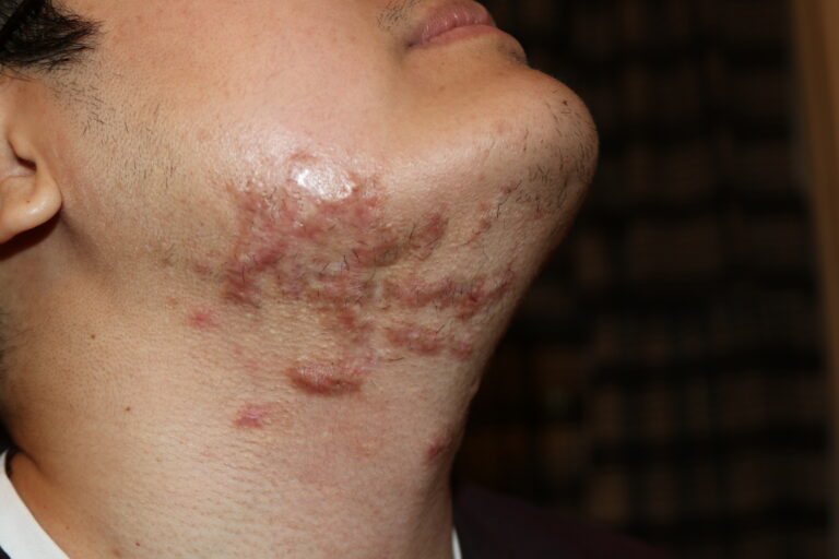 Neck and Face Keloids