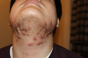 Difuse Neck and Face Keloids treated with intralesional chemotherrapy