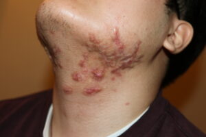 Difuse Neck and Face Keloids treated with intralesional chemotherrapy